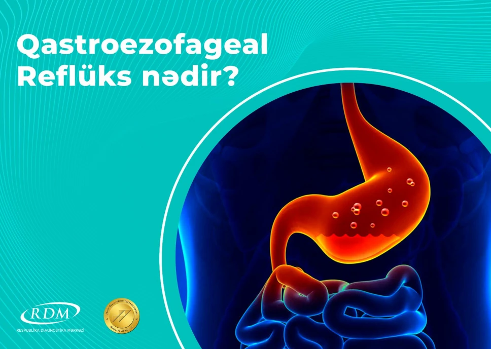 Qastroezofageal Reflüks nədir?